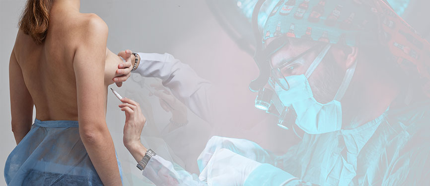 Breast Lift (Mastopexy) 1 Breast Lift.